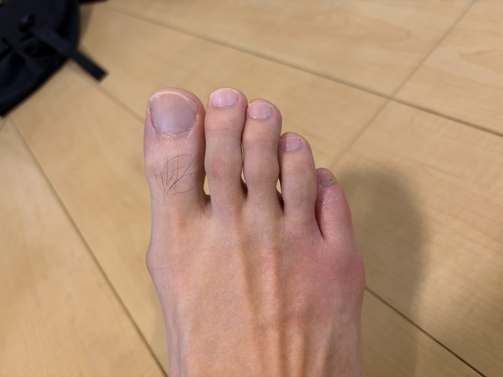 噛まれた直後の右足。